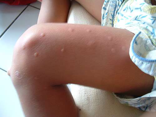 piqures de moustique